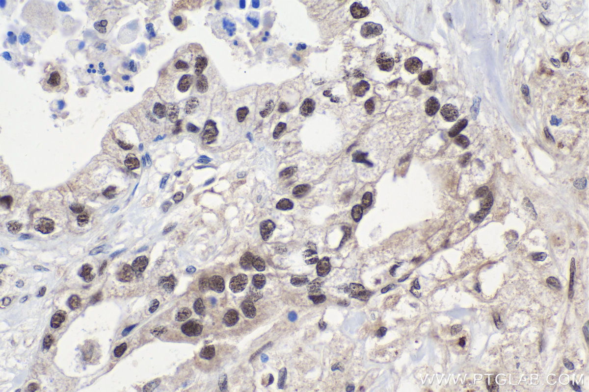 Immunohistochemistry (IHC) staining of human pancreas cancer tissue using CTBP2 Polyclonal antibody (10346-1-AP)