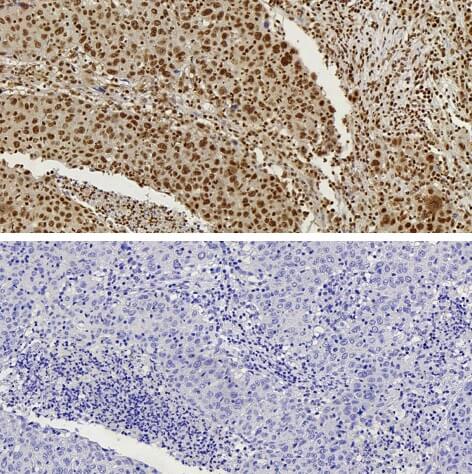 CTCF antibody (pAb) tested by Immunohistochemistry Nuclear staining pattern is detected in Formalin-fixed, paraffin-embedded tissue sections from human breast carcinoma. Top Panel: CTCF antibody at 1:1000 dilution. Bottom Panel: No primary antibody (2nd step antibody alone)