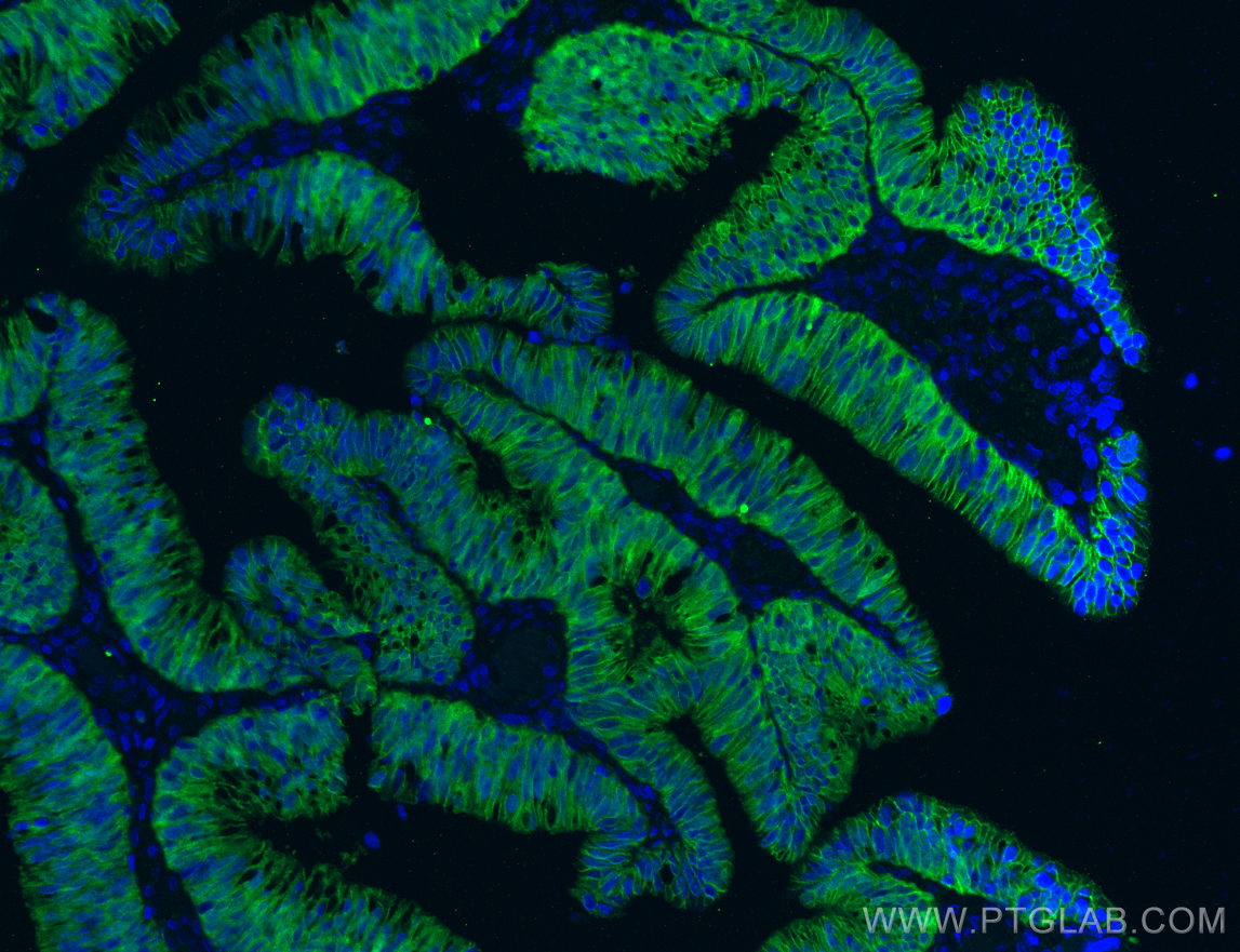 Immunofluorescence (IF) / fluorescent staining of human colon cancer tissue using Beta Catenin Monoclonal antibody (66379-1-Ig)