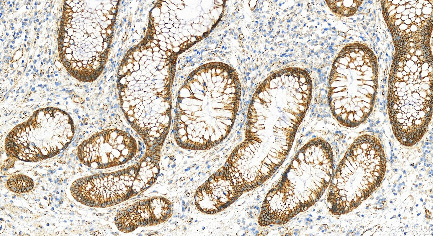 Immunohistochemistry (IHC) staining of human colon cancer tissue using p120 Catenin Polyclonal antibody (12180-1-AP)