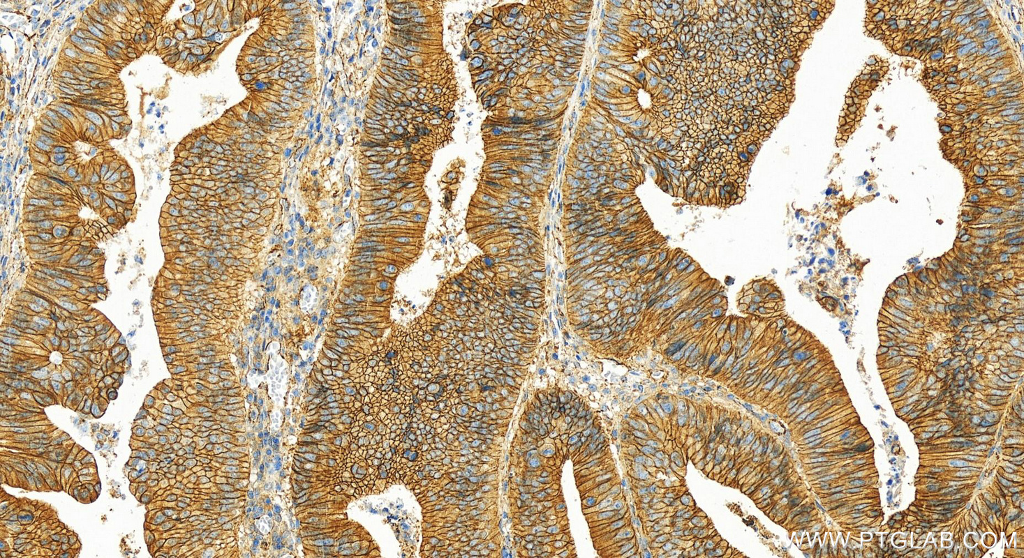 Immunohistochemistry (IHC) staining of human colon cancer tissue using p120 Catenin Polyclonal antibody (12180-1-AP)