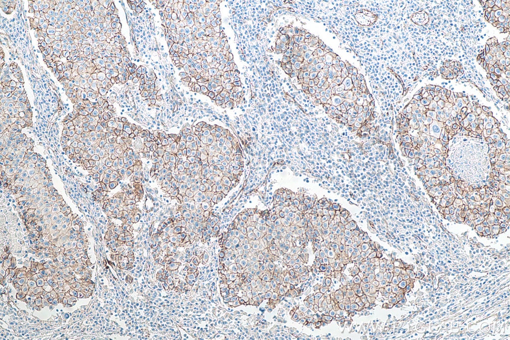 Immunohistochemistry (IHC) staining of human breast cancer tissue using p120 Catenin Monoclonal antibody (66208-1-Ig)