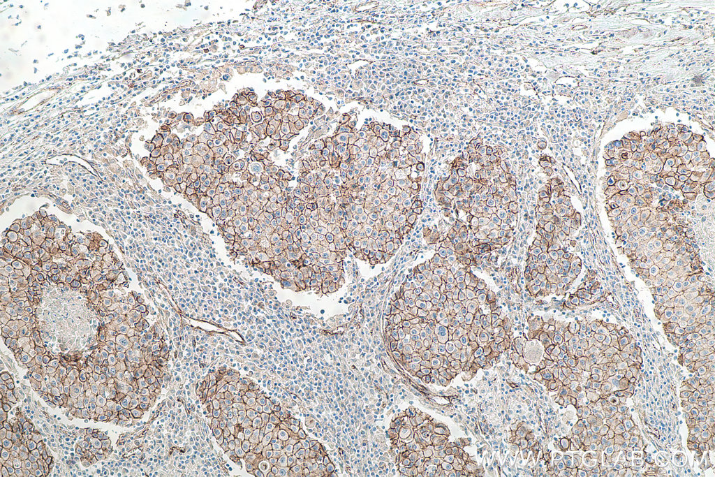 Immunohistochemistry (IHC) staining of human breast cancer tissue using p120 Catenin Monoclonal antibody (66208-1-Ig)