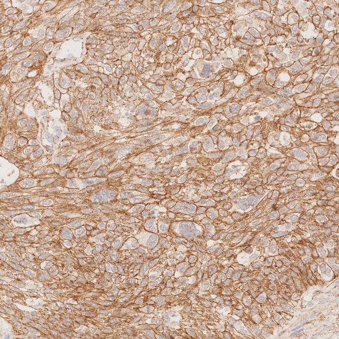Immunohistochemistry (IHC) staining of human ovary cancer tissue using p120 Catenin Monoclonal antibody (66208-1-Ig)