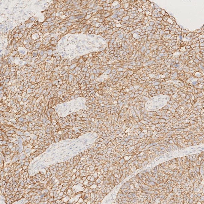 Immunohistochemistry (IHC) staining of human ovary cancer tissue using p120 Catenin Monoclonal antibody (66208-1-Ig)