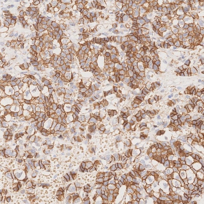 Immunohistochemistry (IHC) staining of human breast cancer tissue using p120 Catenin Monoclonal antibody (66208-1-Ig)