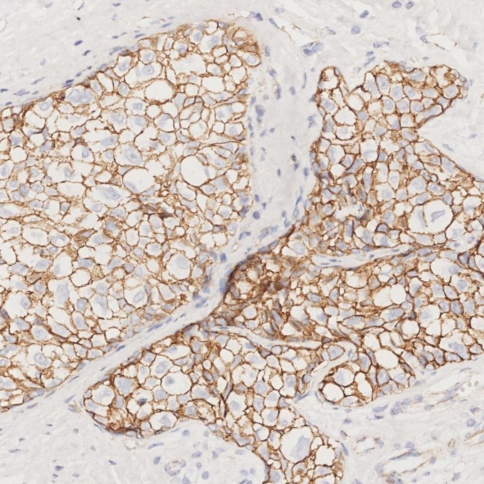 Immunohistochemistry (IHC) staining of human breast cancer tissue using p120 Catenin Monoclonal antibody (66208-1-Ig)