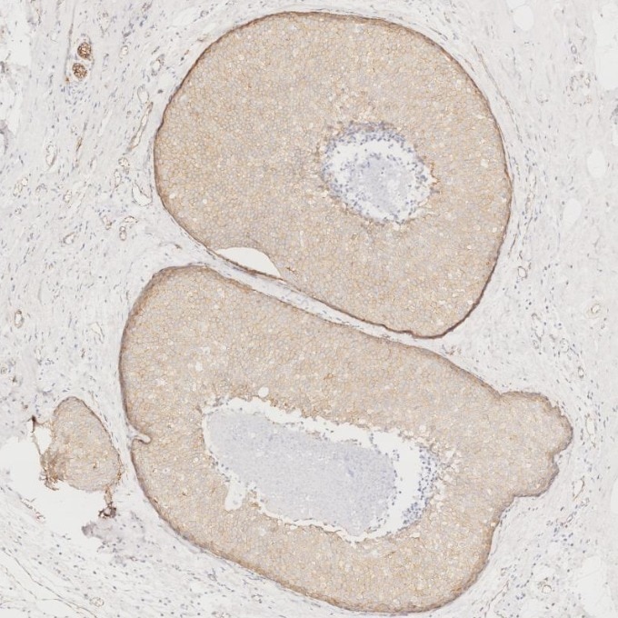 Immunohistochemistry (IHC) staining of human breast cancer tissue using p120 Catenin Monoclonal antibody (66208-1-Ig)