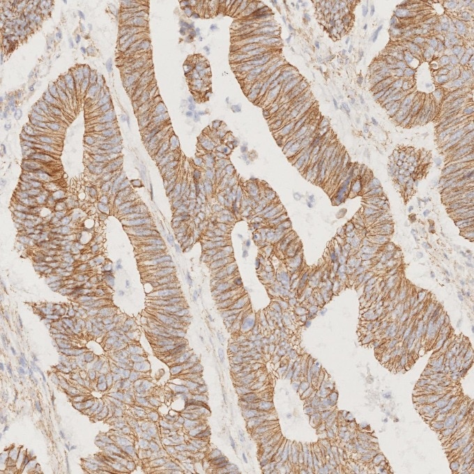 Immunohistochemistry (IHC) staining of human colorectal cancer tissue using p120 Catenin Monoclonal antibody (66208-1-Ig)