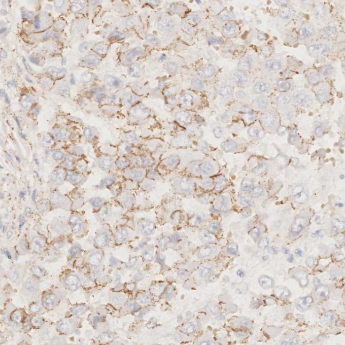 Immunohistochemistry (IHC) staining of human stomach cancer tissue using p120 Catenin Monoclonal antibody (66208-1-Ig)
