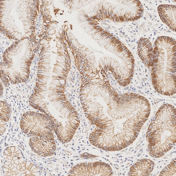 Immunohistochemistry (IHC) staining of human stomach cancer tissue using p120 Catenin Monoclonal antibody (66208-1-Ig)