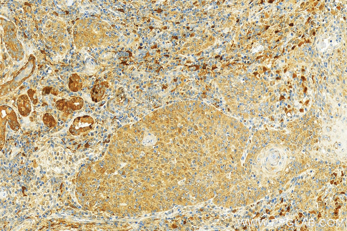 Immunohistochemistry (IHC) staining of human skin cancer tissue using Cathepsin V Polyclonal antibody (18442-1-AP)