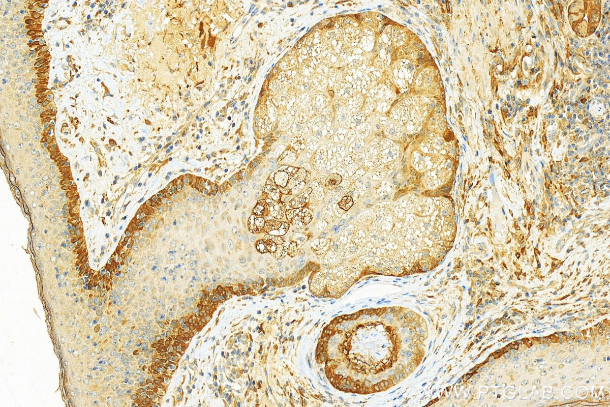 Immunohistochemistry (IHC) staining of human skin cancer tissue using Cathepsin V Polyclonal antibody (18442-1-AP)