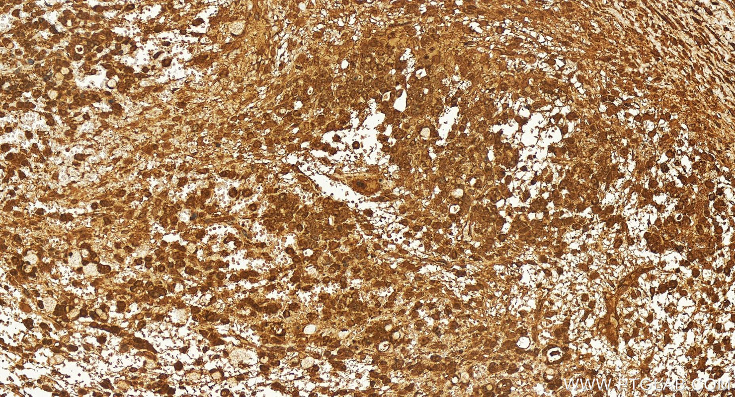 Immunohistochemistry (IHC) staining of human ovary cancer tissue using CTTNBP2NL Polyclonal antibody (25523-1-AP)