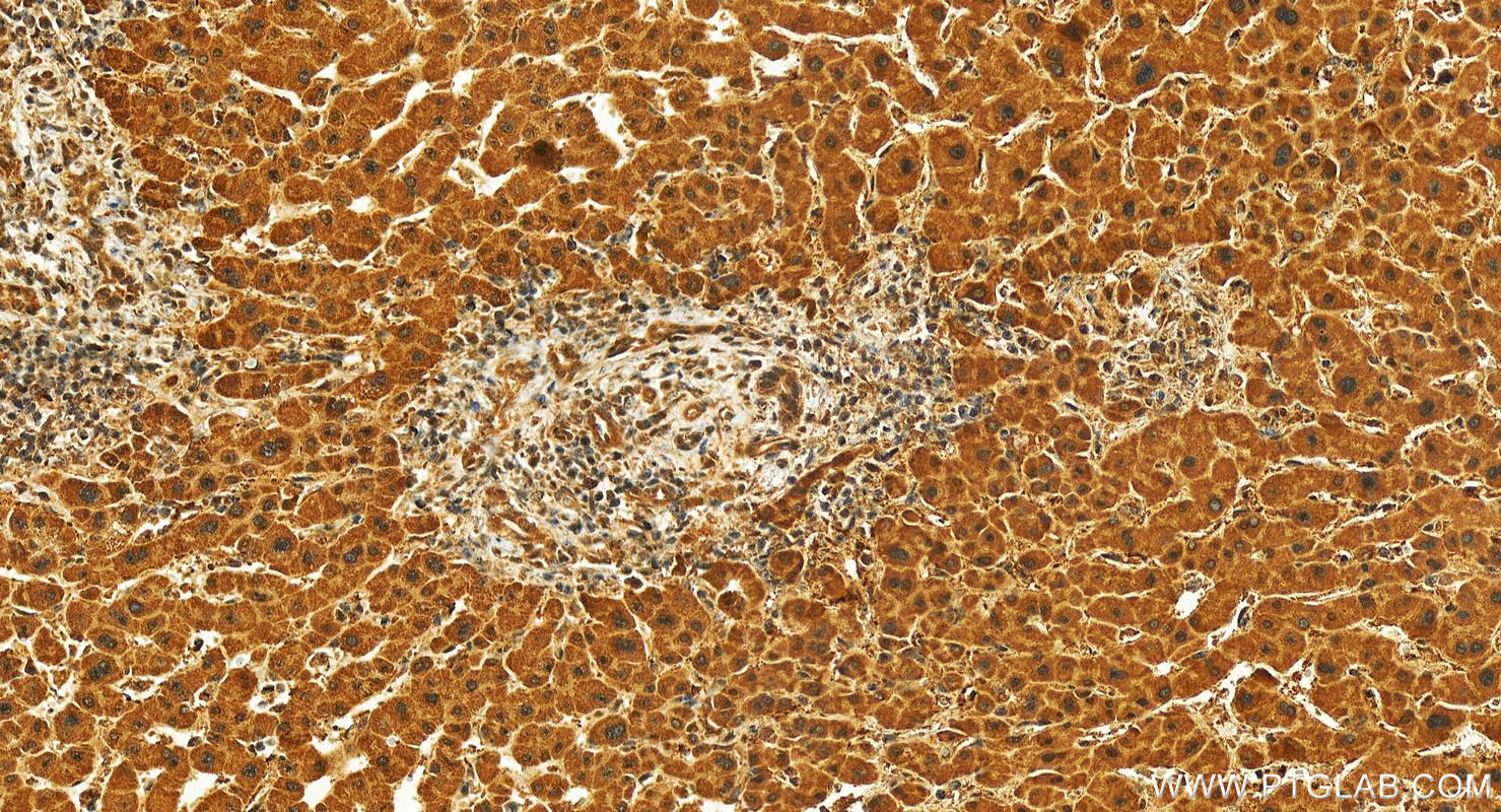 Immunohistochemistry (IHC) staining of human intrahepatic cholangiocarcinoma tissue using CWC22 Polyclonal antibody (26898-1-AP)