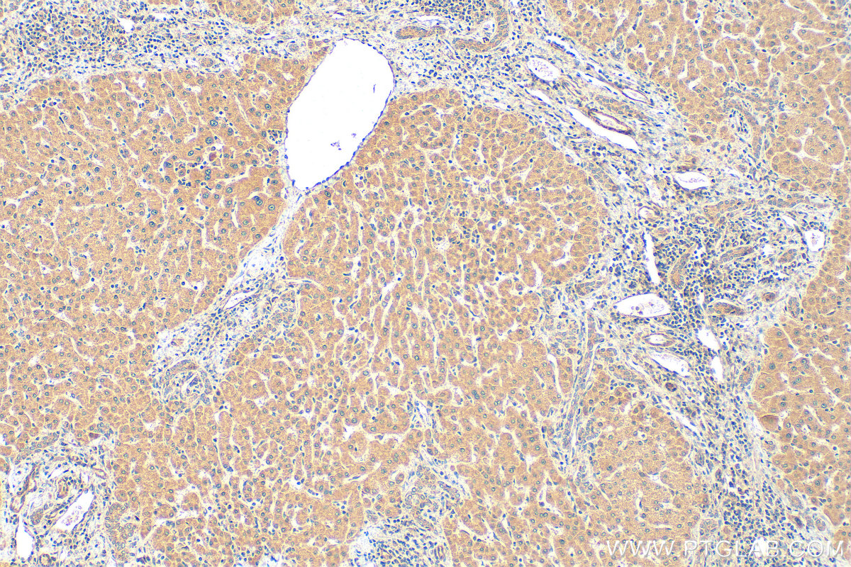 Immunohistochemistry (IHC) staining of human hepatocirrhosis tissue using CXCL10/IP-10 Polyclonal antibody (10937-1-AP)