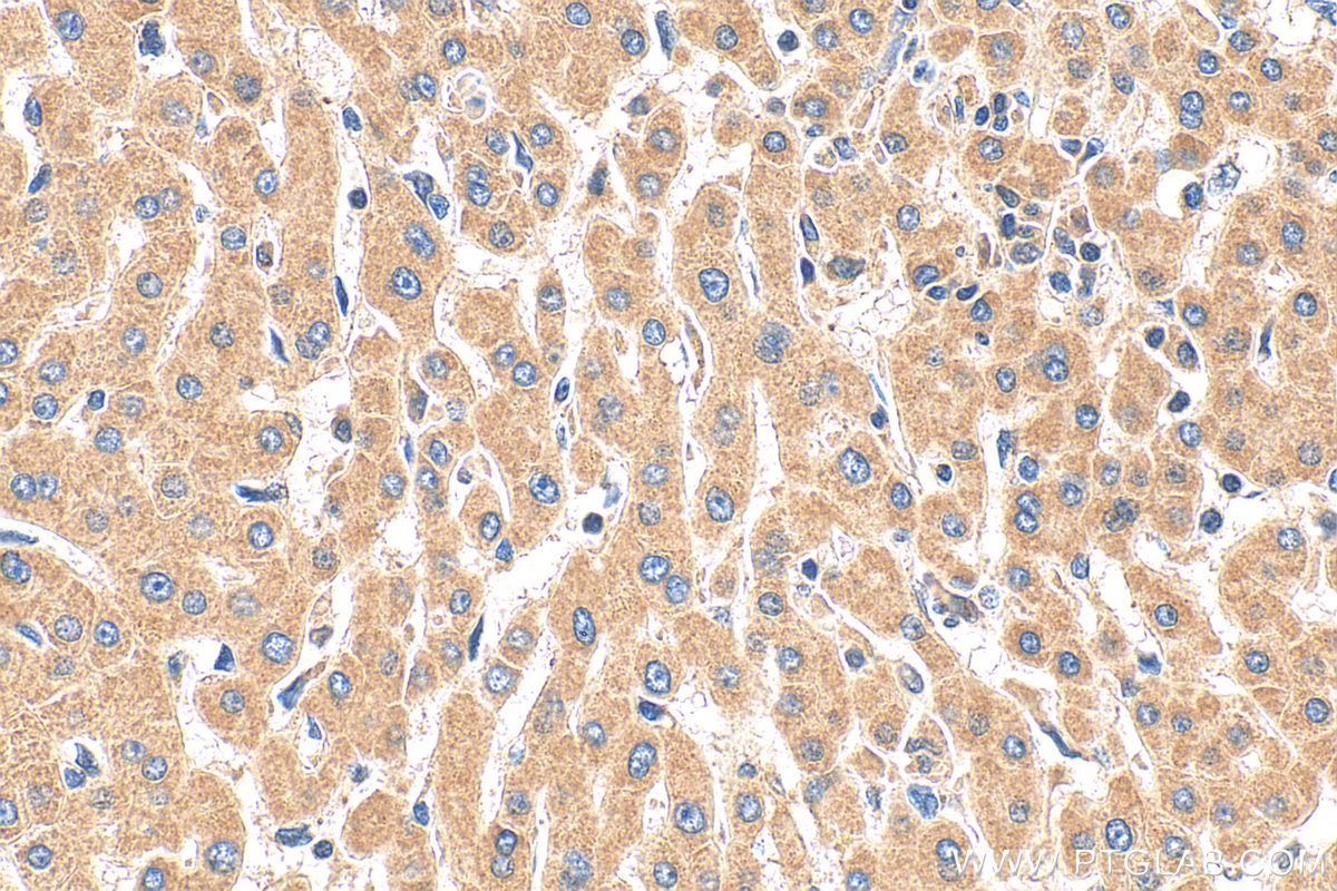 Immunohistochemistry (IHC) staining of human hepatocirrhosis tissue using CXCL10/IP-10 Polyclonal antibody (10937-1-AP)