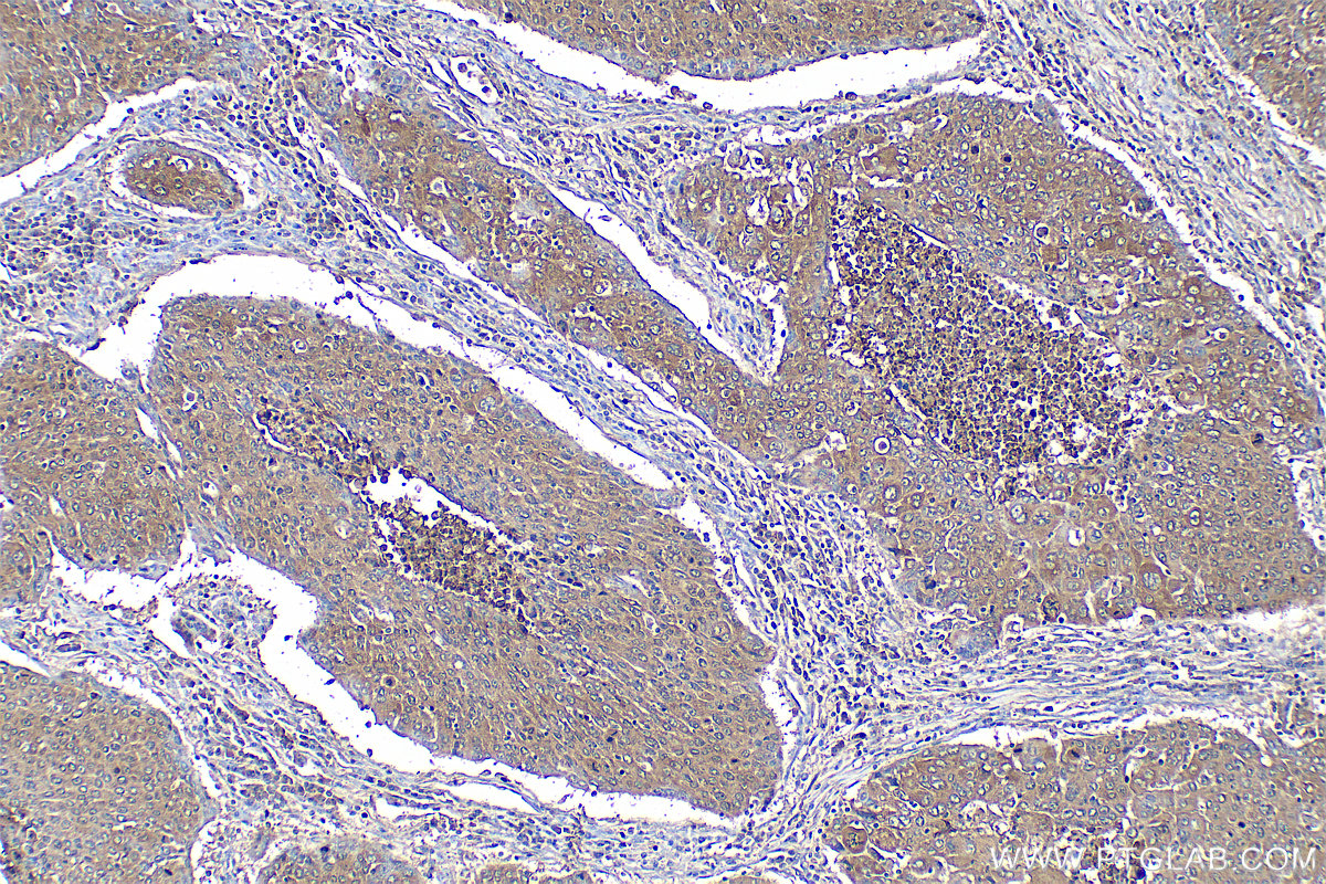 Immunohistochemistry (IHC) staining of human lung cancer tissue using CXCL12/SDF-1 Polyclonal antibody (17402-1-AP)