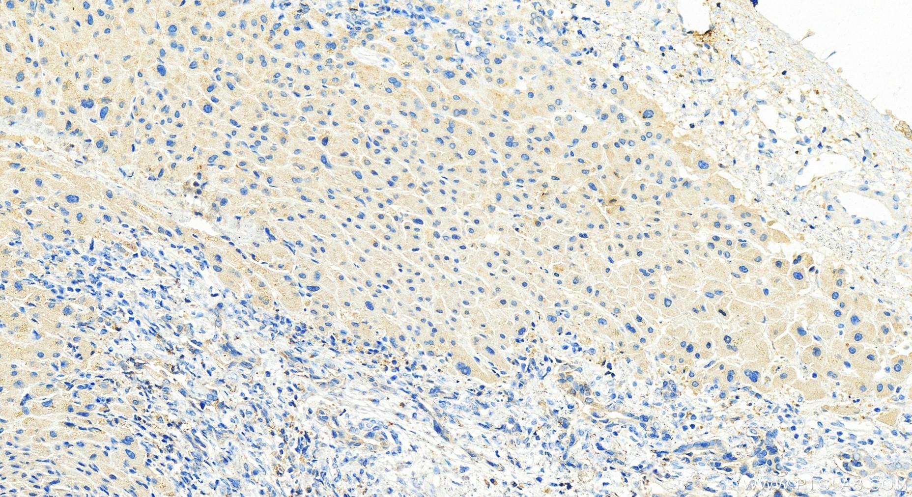 Immunohistochemistry (IHC) staining of human intrahepatic cholangiocarcinoma tissue using CXCL5 Polyclonal antibody (10809-1-AP)