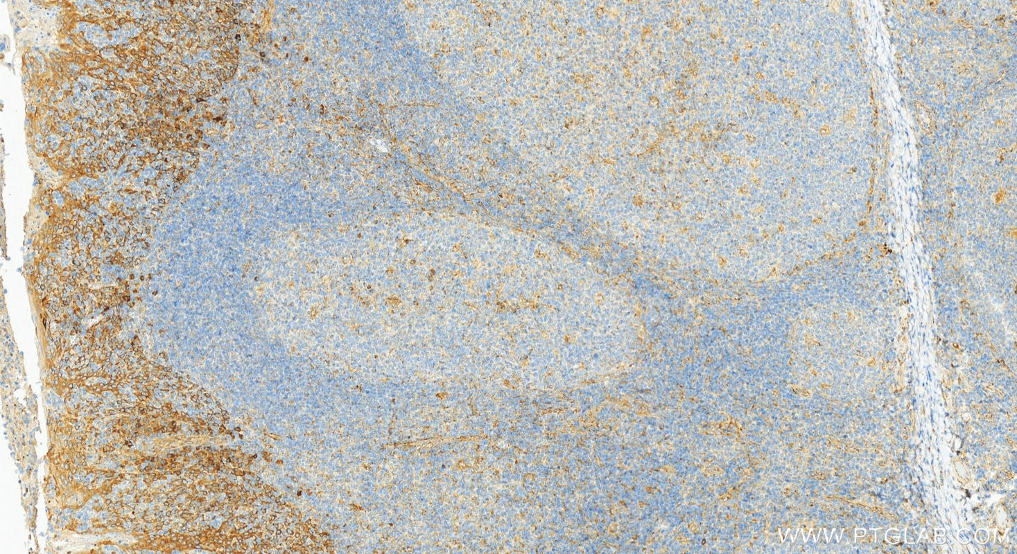 Immunohistochemistry (IHC) staining of human tonsillitis tissue using CXCL8/IL-8 Polyclonal antibody (31533-1-AP)