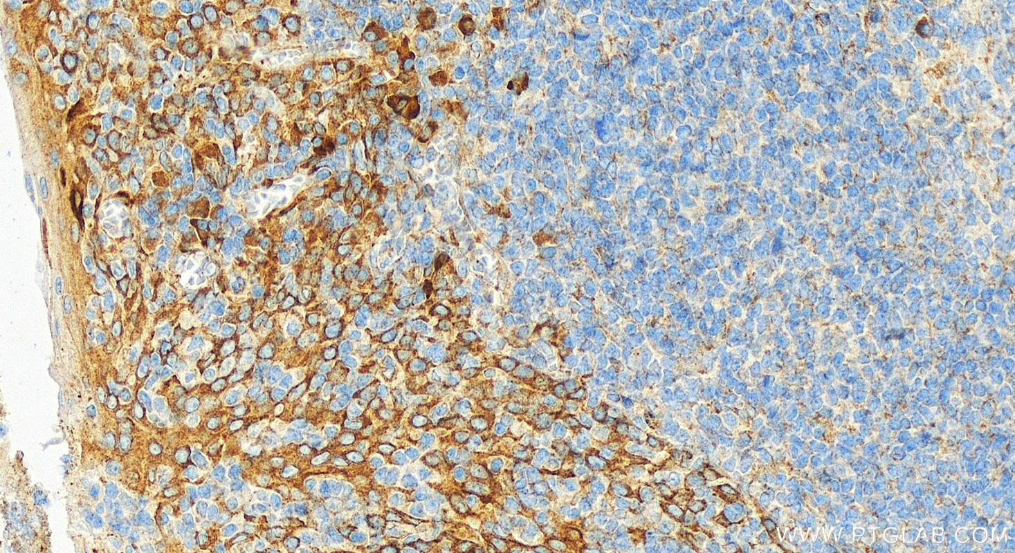 Immunohistochemistry (IHC) staining of human tonsillitis tissue using CXCL8/IL-8 Polyclonal antibody (31533-1-AP)