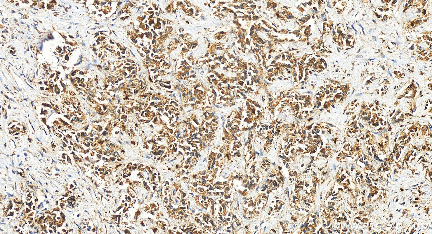 Immunohistochemistry (IHC) staining of human intrahepatic cholangiocarcinoma tissue using CXCL8/IL-8 Polyclonal antibody (27095-1-AP)