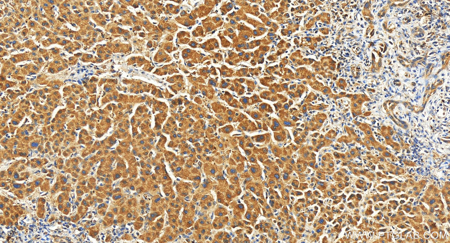 Immunohistochemistry (IHC) staining of human intrahepatic cholangiocarcinoma tissue using CXCL8/IL-8 Polyclonal antibody (27095-1-AP)