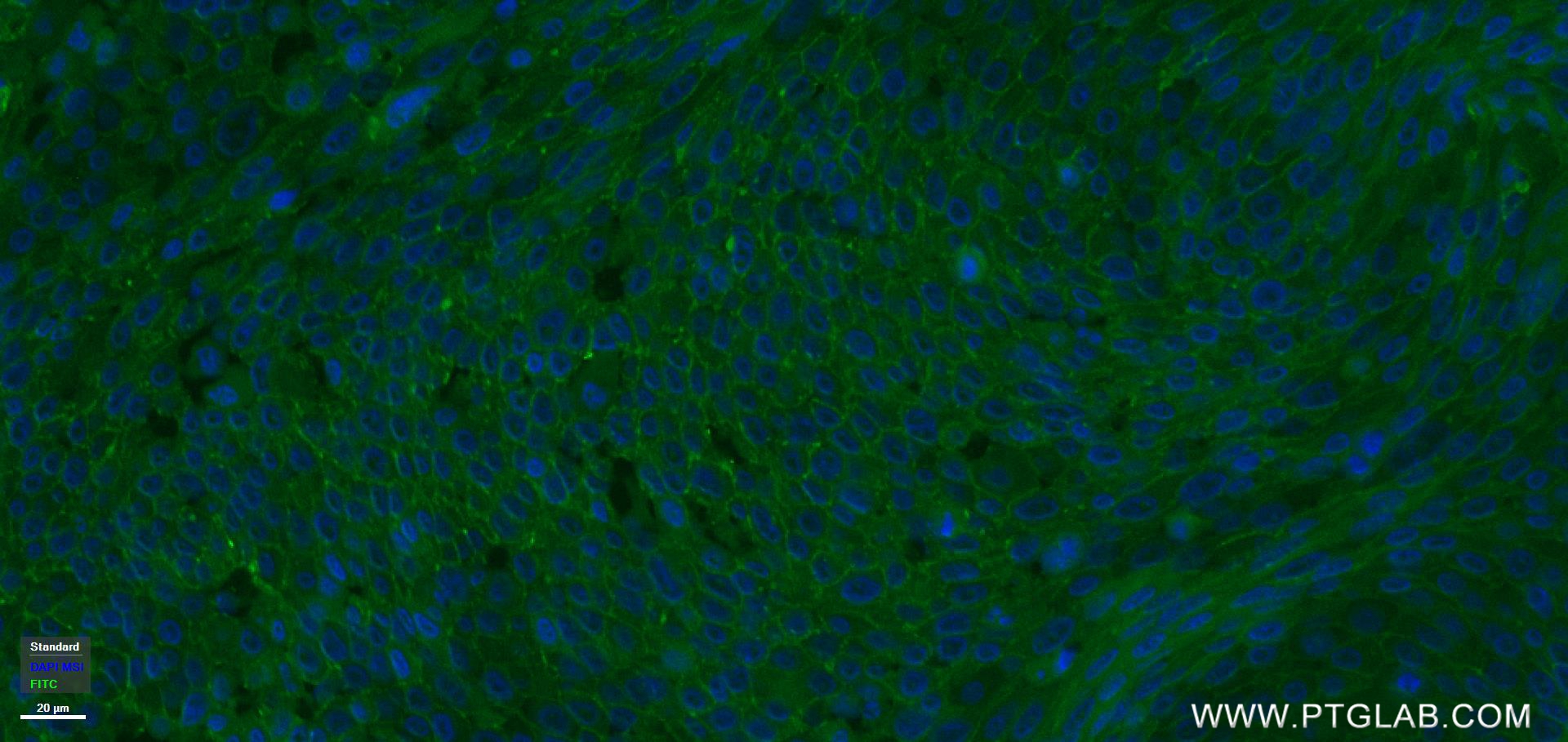 Immunofluorescence (IF) / fluorescent staining of human lung cancer tissue using CXCR6 Recombinant antibody (84591-1-RR)