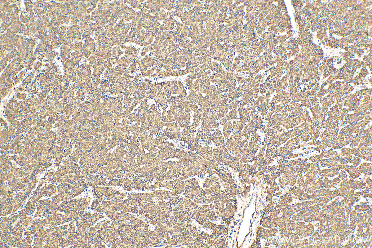 Immunohistochemistry (IHC) staining of human liver cancer tissue using CYP1A1 Polyclonal antibody (13241-1-AP)