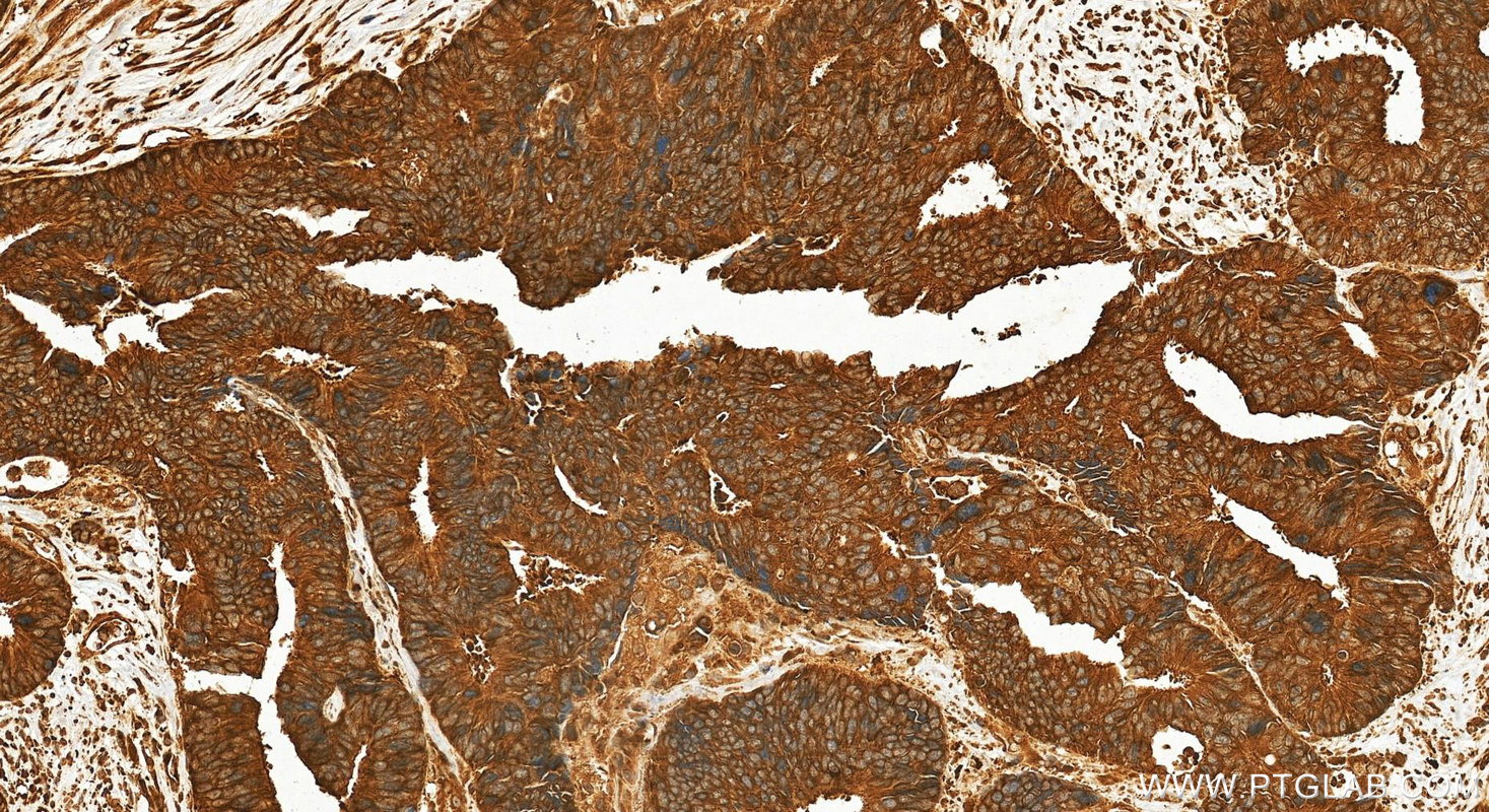 Immunohistochemistry (IHC) staining of human colon cancer tissue using CYP1B1 Polyclonal antibody (18505-1-AP)