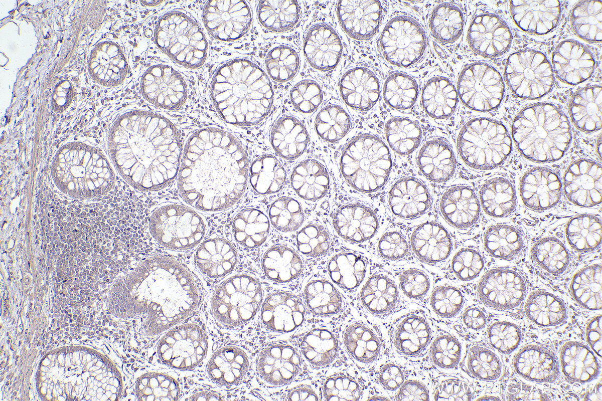 Immunohistochemistry (IHC) staining of human rectal cancer tissue using CYP1B1 Monoclonal antibody (67033-1-Ig)