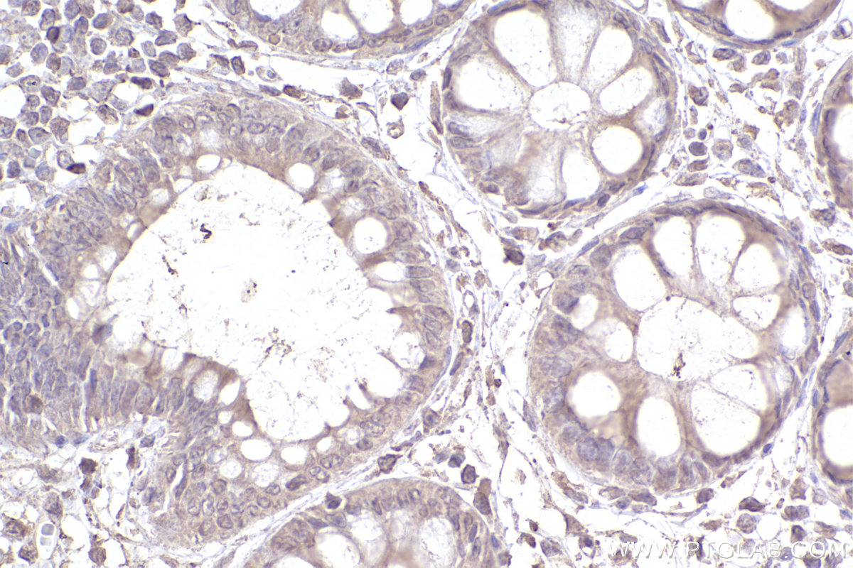 Immunohistochemistry (IHC) staining of human rectal cancer tissue using CYP1B1 Monoclonal antibody (67033-1-Ig)