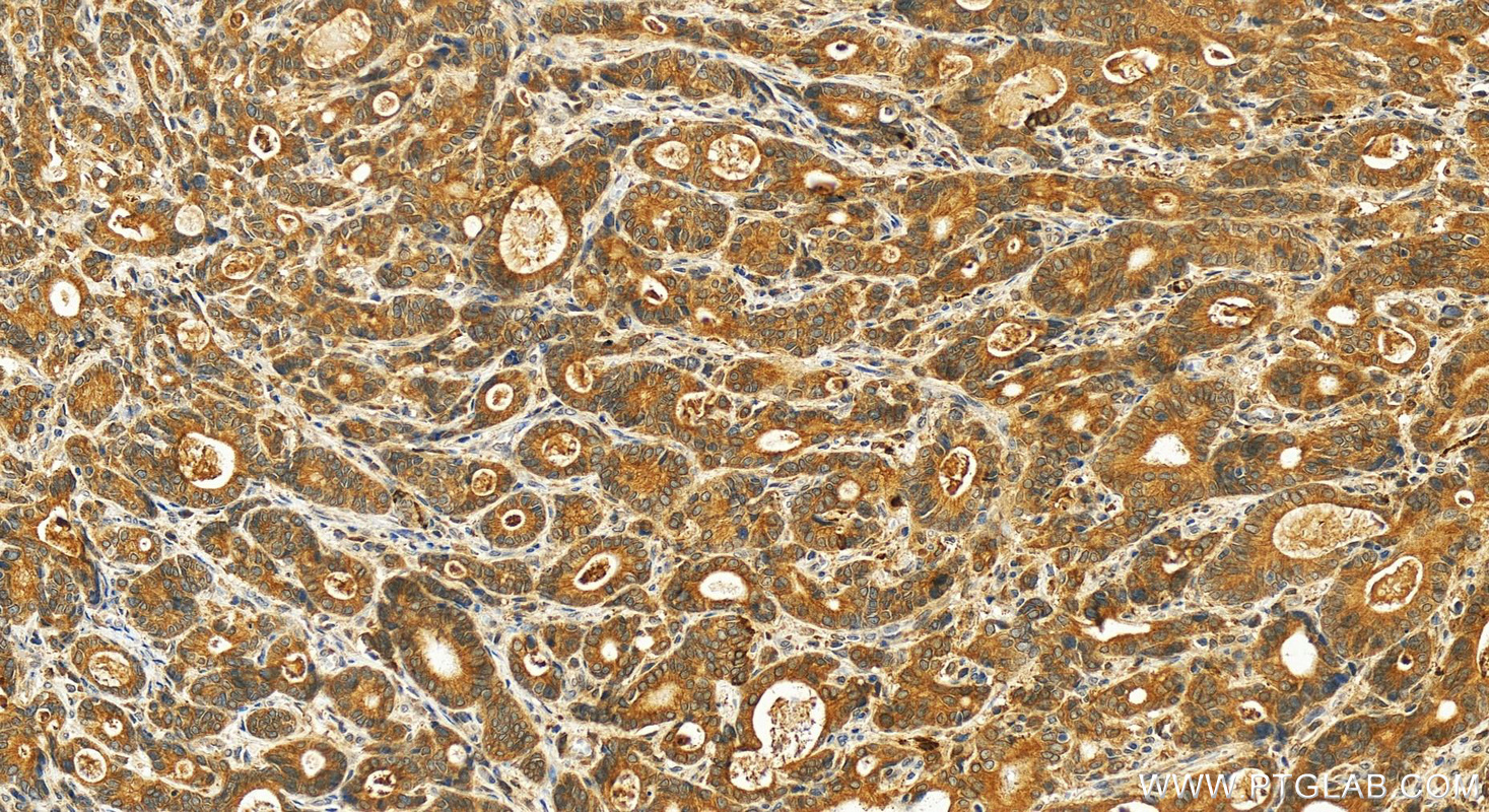 Immunohistochemistry (IHC) staining of human stomach cancer tissue using CYP2S1 Polyclonal antibody (13654-1-AP)