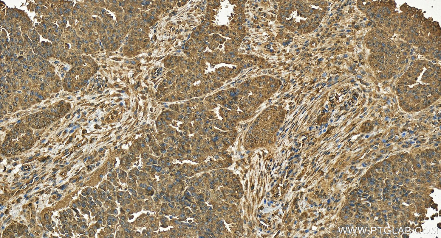 Immunohistochemistry (IHC) staining of human ovarian  cancer using CYP2S1 Polyclonal antibody (19100-1-AP)