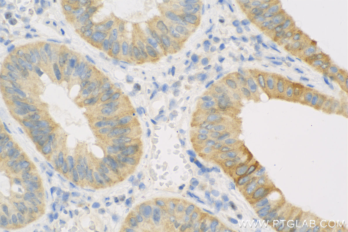 Immunohistochemistry (IHC) staining of Human Colon cancer tissue using CYP2W1 Polyclonal antibody (12904-1-AP)