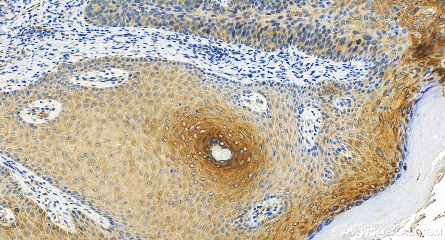 Immunohistochemistry (IHC) staining of human bowen disease using CYP4F11 Polyclonal antibody (12286-1-AP)