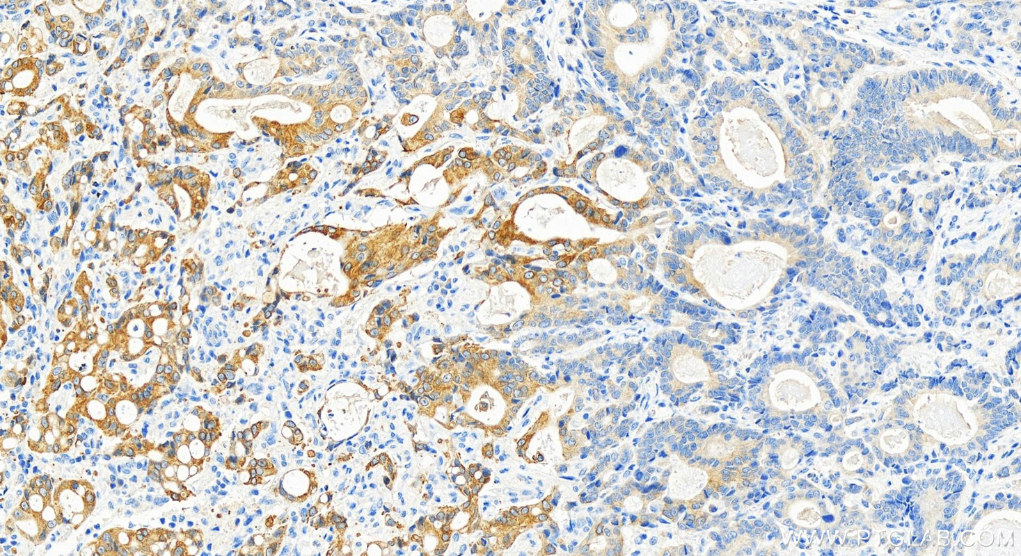 Immunohistochemistry (IHC) staining of human stomach cancer tissue using CYP4F12 Polyclonal antibody (13243-1-AP)