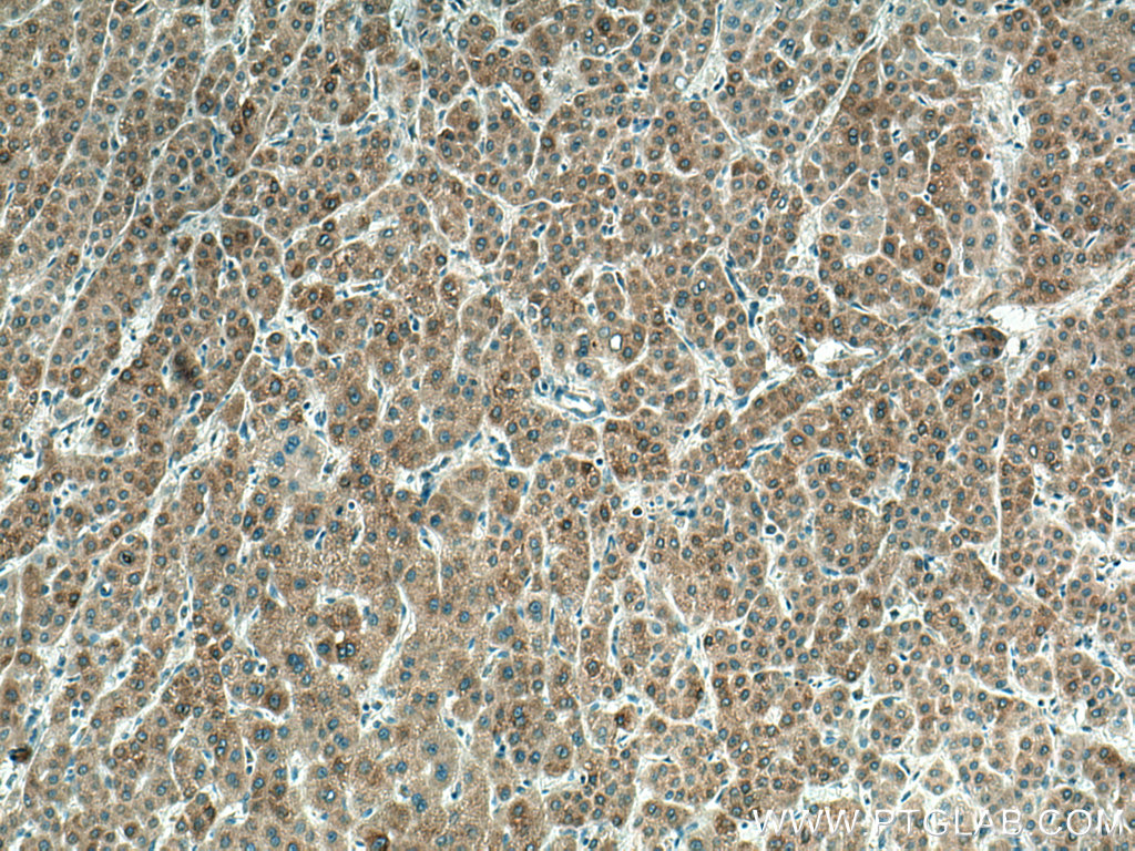 Immunohistochemistry (IHC) staining of human liver cancer tissue using CYP7A1 Polyclonal antibody (18054-1-AP)