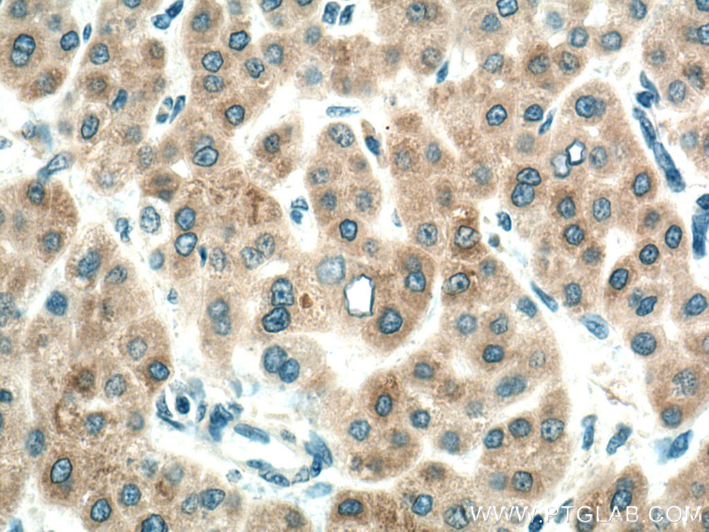 Immunohistochemistry (IHC) staining of human liver cancer tissue using CYP7A1 Polyclonal antibody (18054-1-AP)