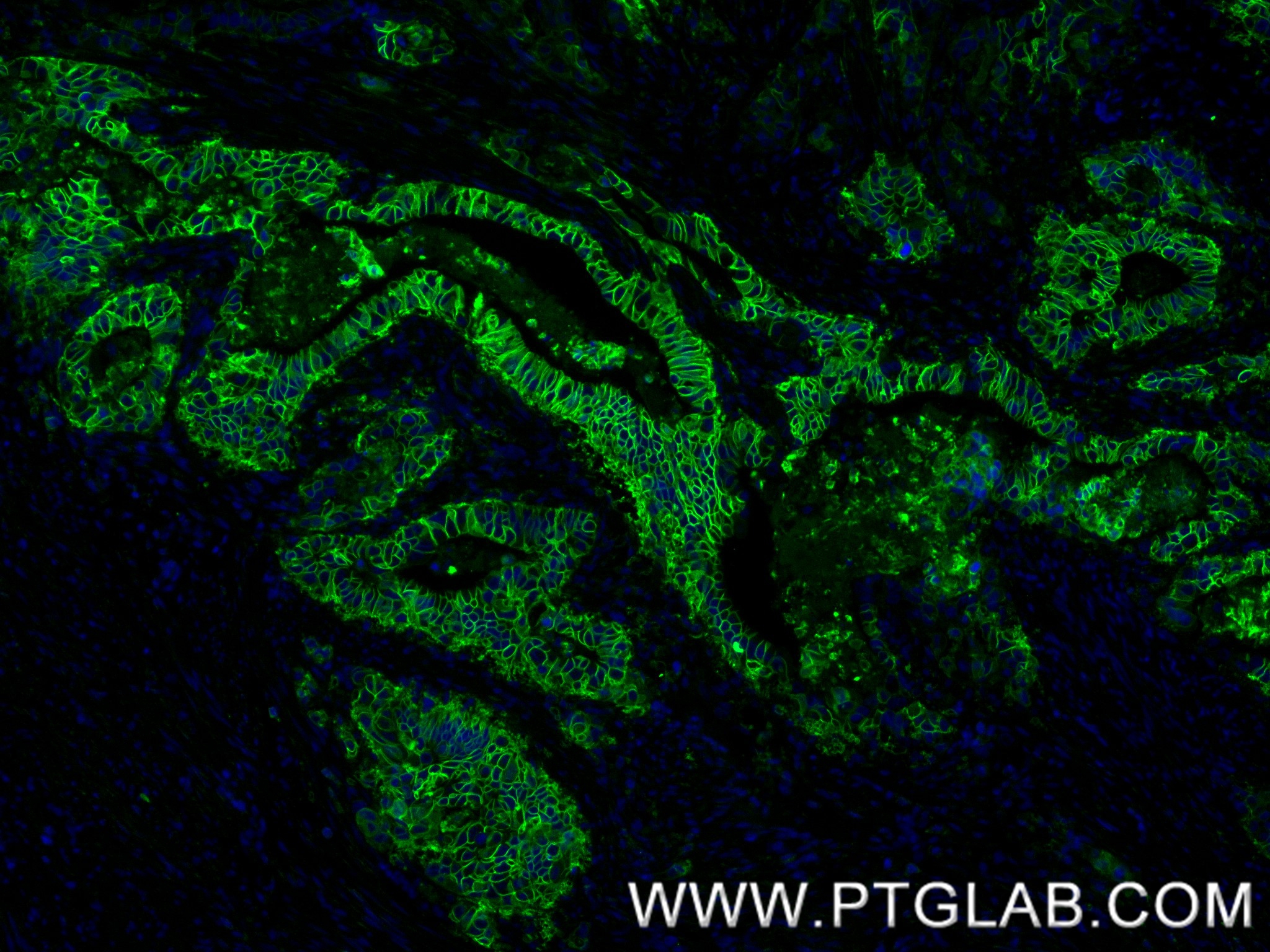 Immunofluorescence (IF) / fluorescent staining of human stomach cancer tissue using Cadherin-17 Recombinant antibody (83793-5-RR)