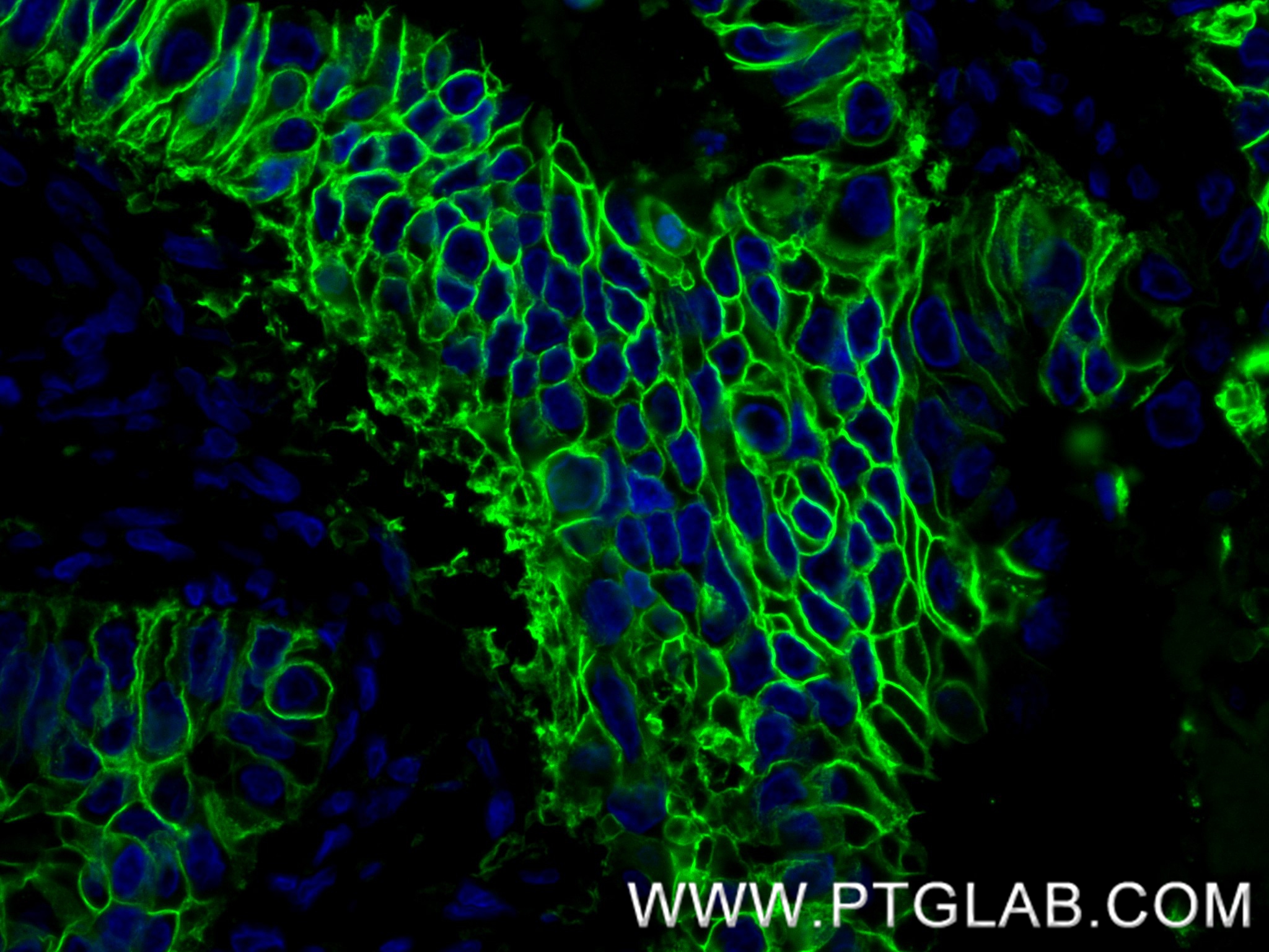 Immunofluorescence (IF) / fluorescent staining of human stomach cancer tissue using Cadherin-17 Recombinant antibody (83793-5-RR)