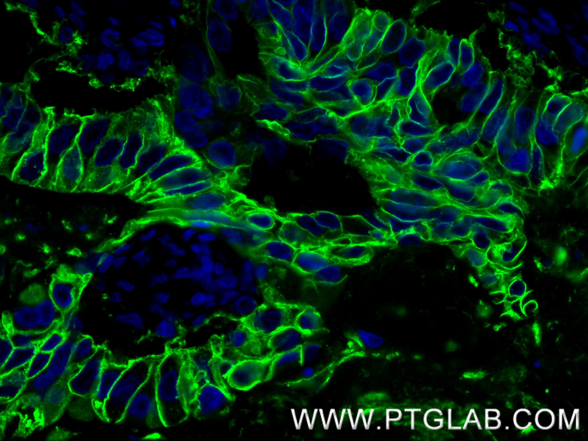 Immunofluorescence (IF) / fluorescent staining of human stomach cancer tissue using Cadherin-17 Recombinant antibody (83793-5-RR)