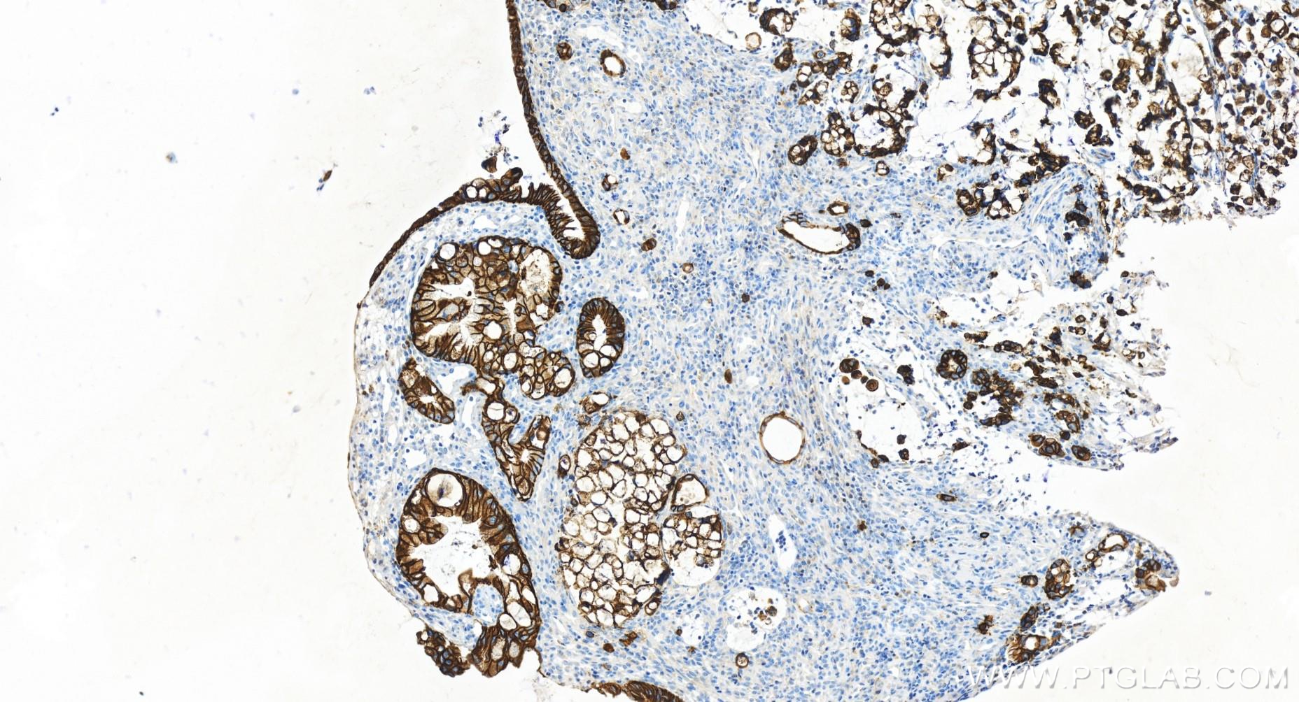 Immunohistochemistry (IHC) staining of human colon cancer tissue using Cadherin-17 Recombinant antibody (83793-5-RR)