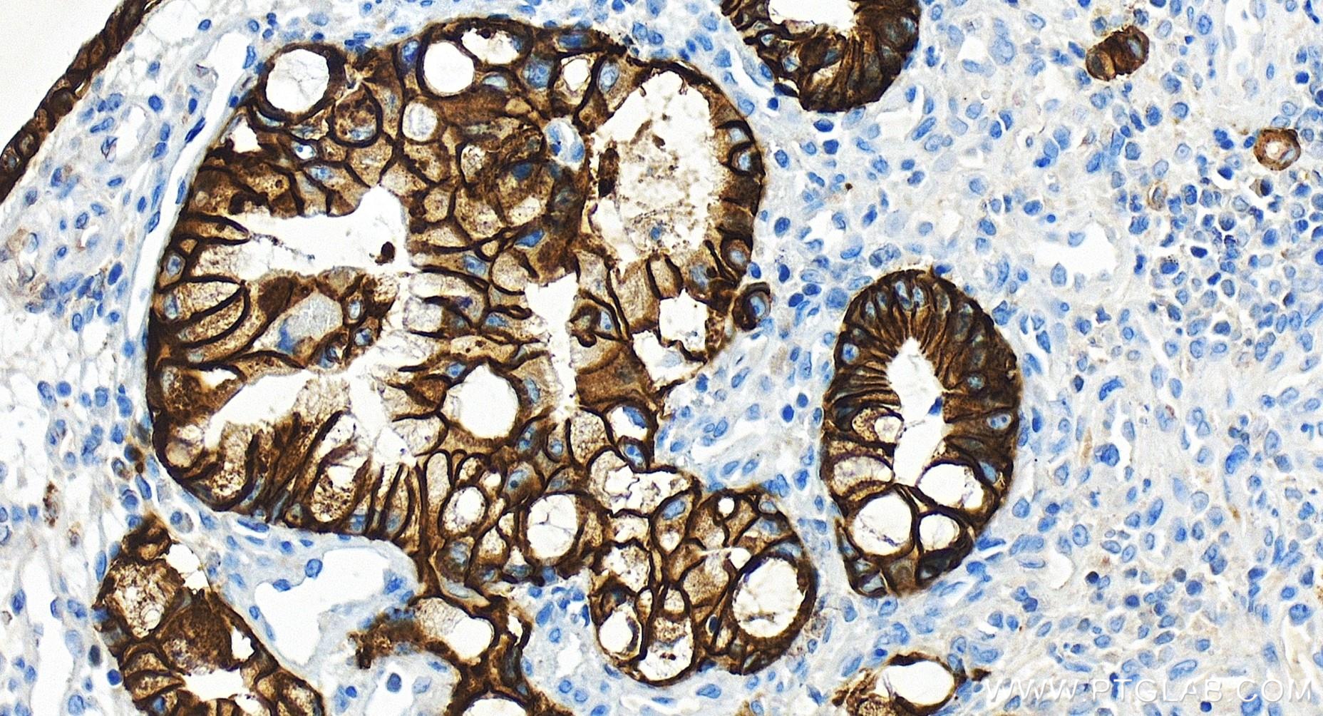 Immunohistochemistry (IHC) staining of human colon cancer tissue using Cadherin-17 Recombinant antibody (83793-5-RR)