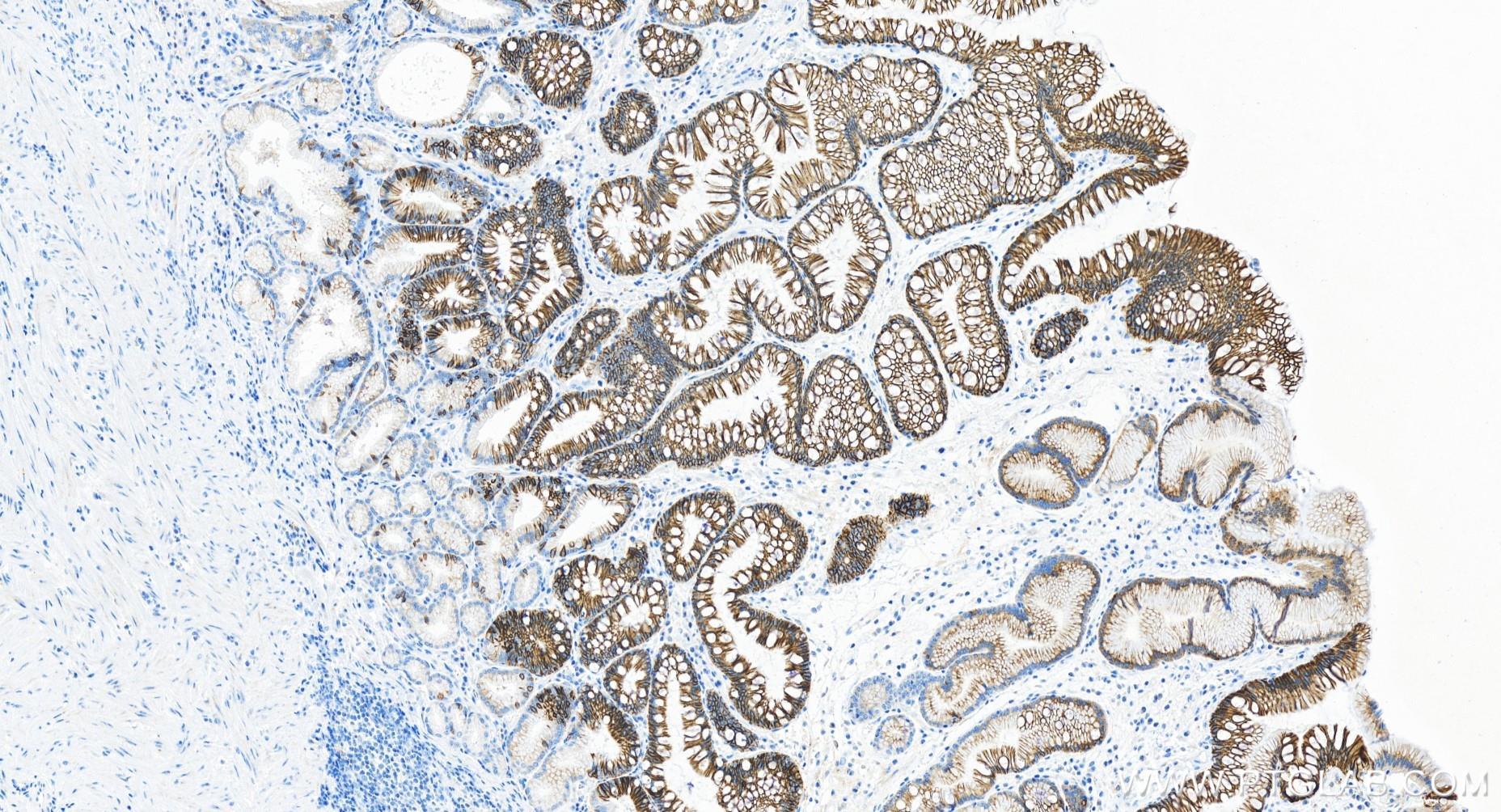 Immunohistochemistry (IHC) staining of human stomach cancer tissue using Cadherin-17 Recombinant antibody (83793-5-RR)