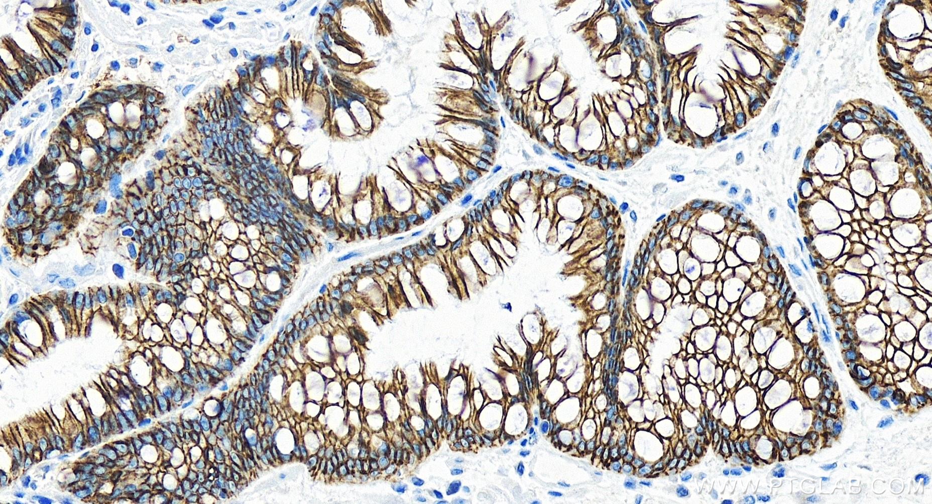 Immunohistochemistry (IHC) staining of human stomach cancer tissue using Cadherin-17 Recombinant antibody (83793-5-RR)