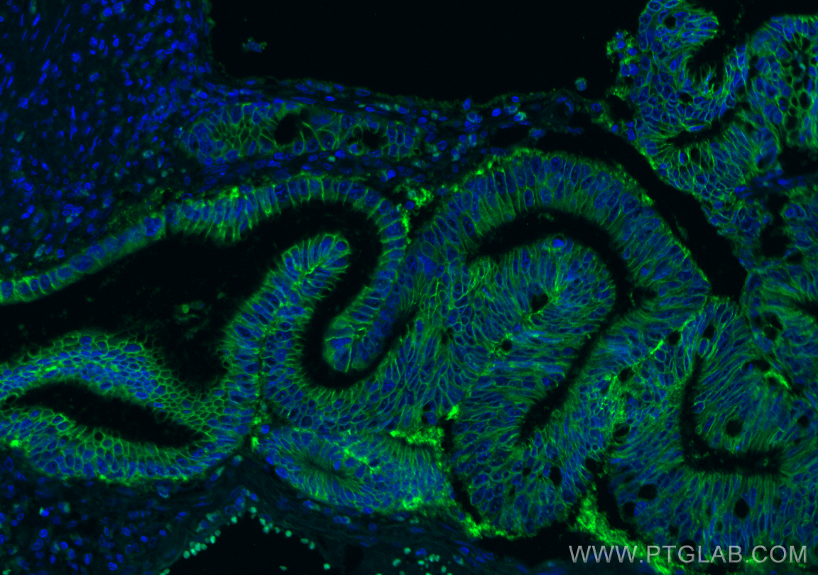 Immunofluorescence (IF) / fluorescent staining of human colon cancer tissue using CoraLite® Plus 488-conjugated Cadherin-17 Monoclon (CL488-60351)