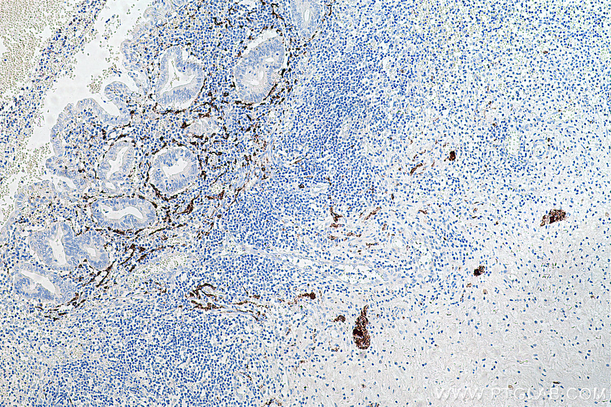 Immunohistochemistry (IHC) staining of human appendicitis tissue using Calretinin Monoclonal antibody (66496-1-Ig)