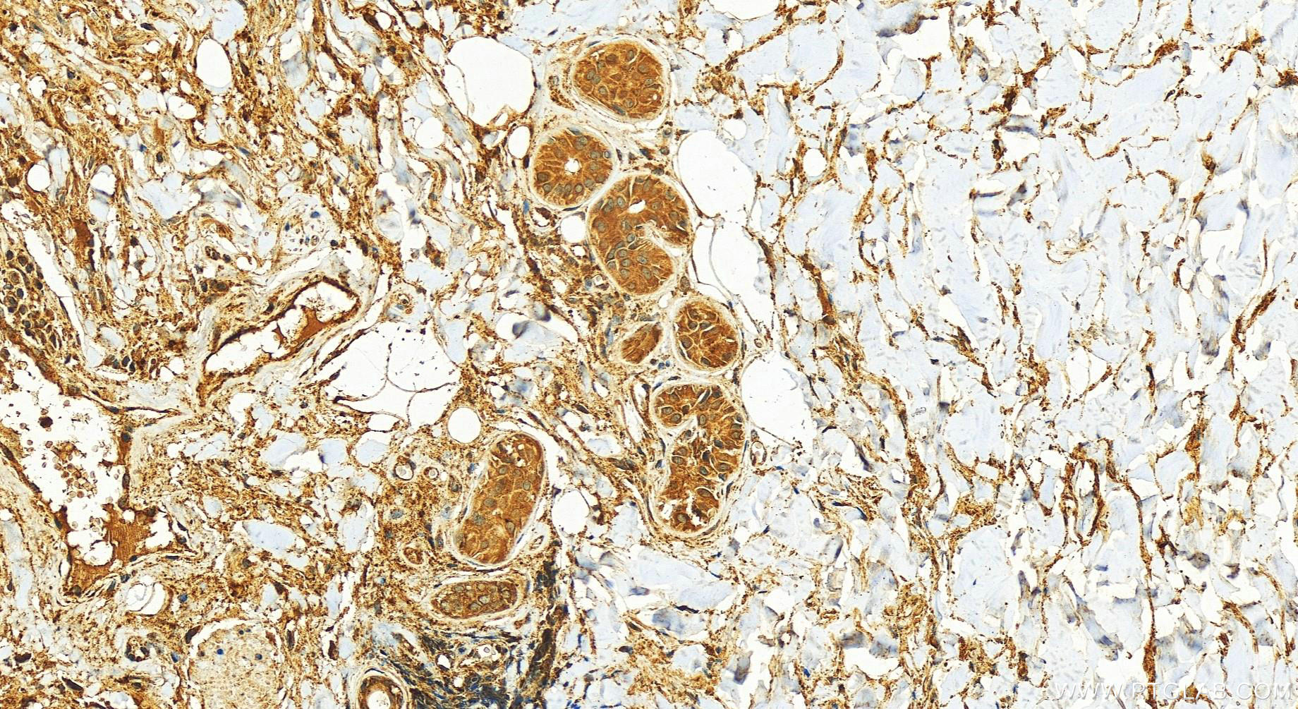 Immunohistochemistry (IHC) staining of human skin cancer tissue using Cathepsin C Polyclonal antibody (30790-1-AP)