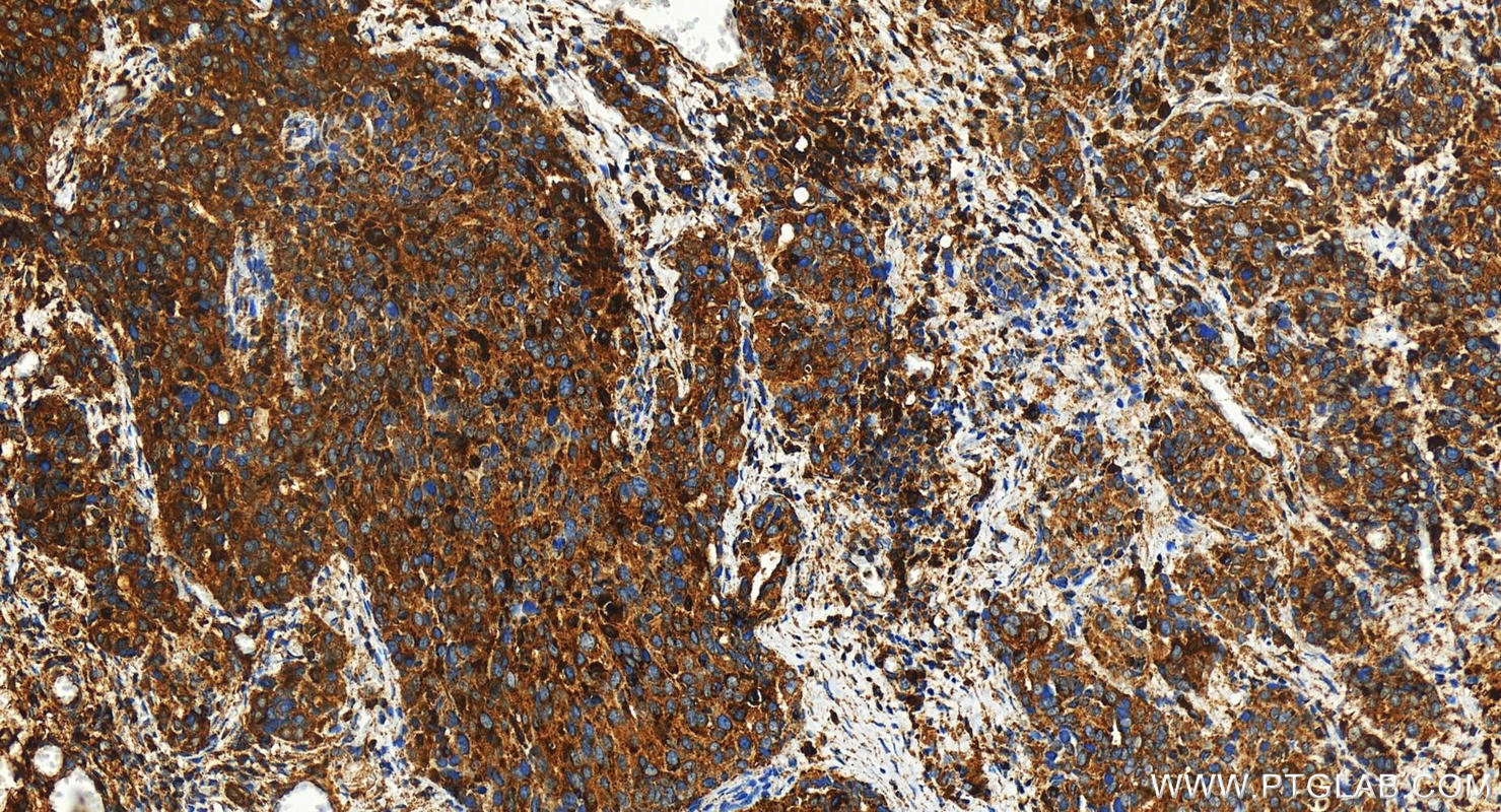 Immunohistochemistry (IHC) staining of human ovary cancer tissue using Cathepsin D Polyclonal antibody (31516-1-AP)